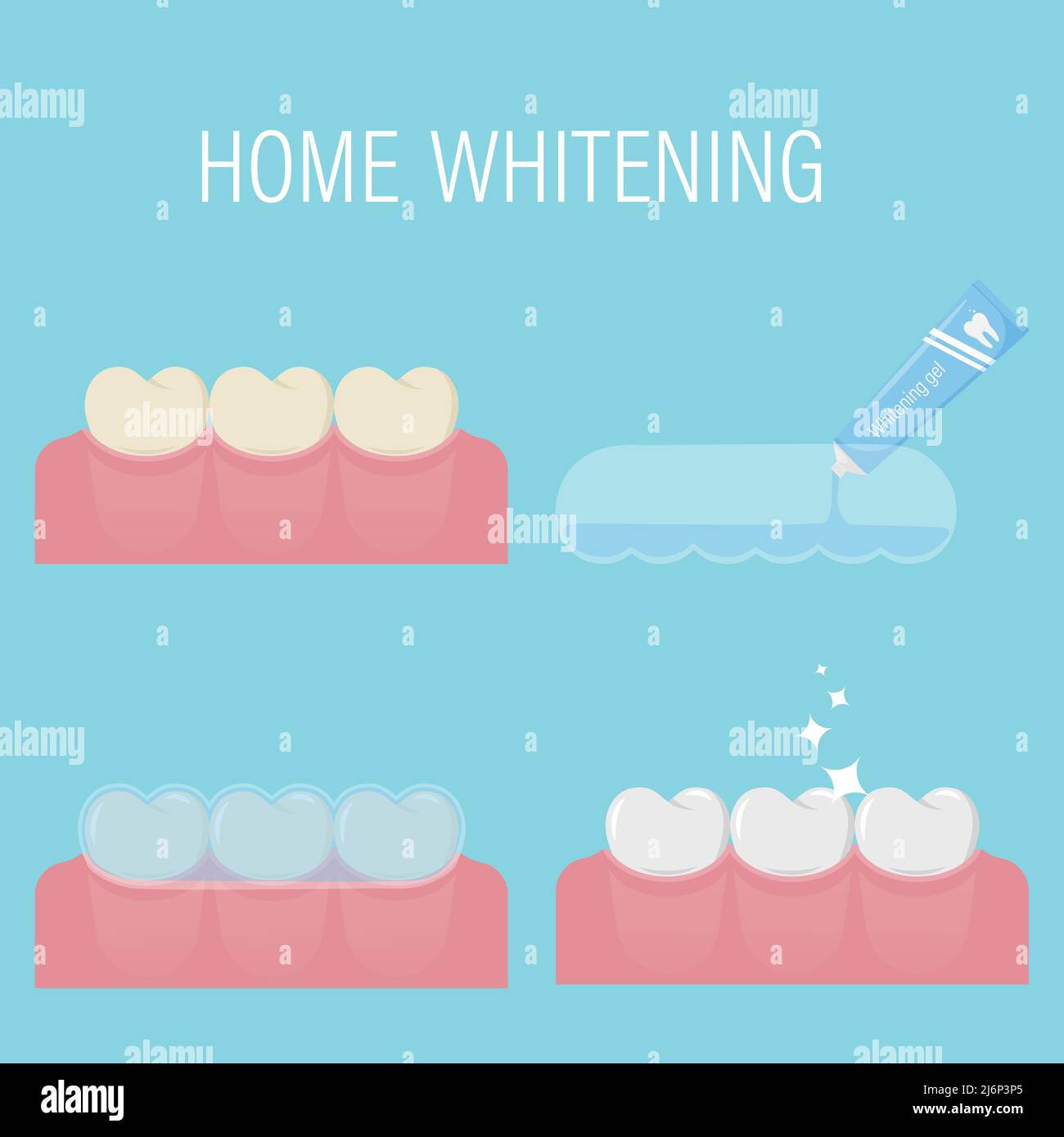 Le concept de blanchiment des dents à la maison du jaune au blanc. Stades consécutifs de blanchiment avec gel et protecteur buccal à la maison.avant et après. Moderne com Illustration de Vecteur Le concept de blanchiment des dents à la maison du jaune au blanc. Stades consécutifs de blanchiment avec gel et protecteur buccal à la maison.avant et après. Moderne com Illustration de Vecteur