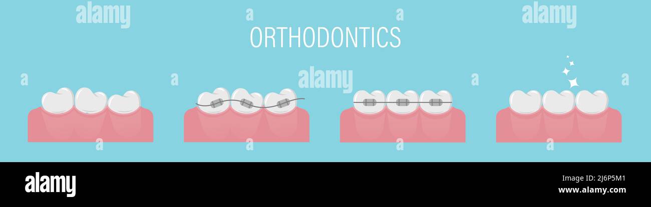 Le concept de l'alignement des dents avec les accolades. Affiche avec dents tortravers, dans les bretelles et en bonne santé même. Dents simples en rangée. Traitement orthodontique. Isola Illustration de Vecteur