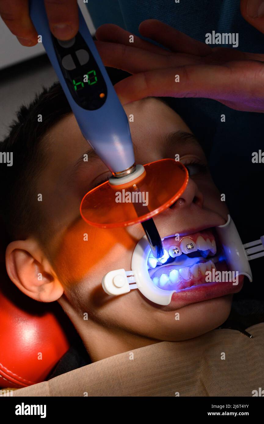 Alignement de dents de travers à l'aide d'accolades, installation d'accolades pour enfants, colles orthodontistes plaques métalliques entretoises pour l'alignement des dents, Banque D'Images