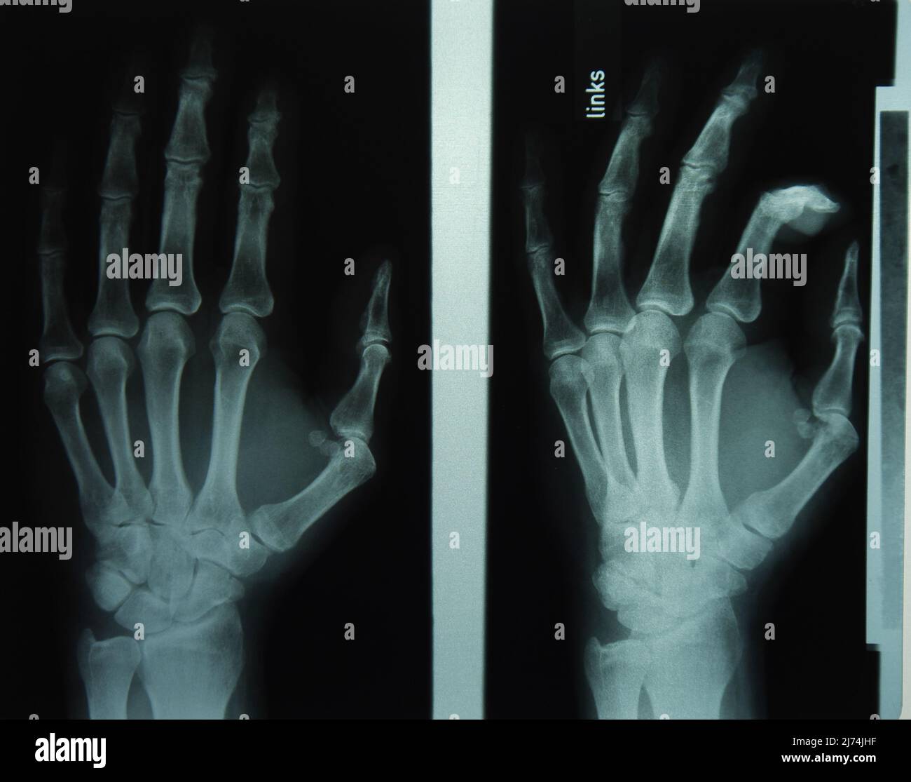 Röntgenbild der beiden Hände Banque D'Images