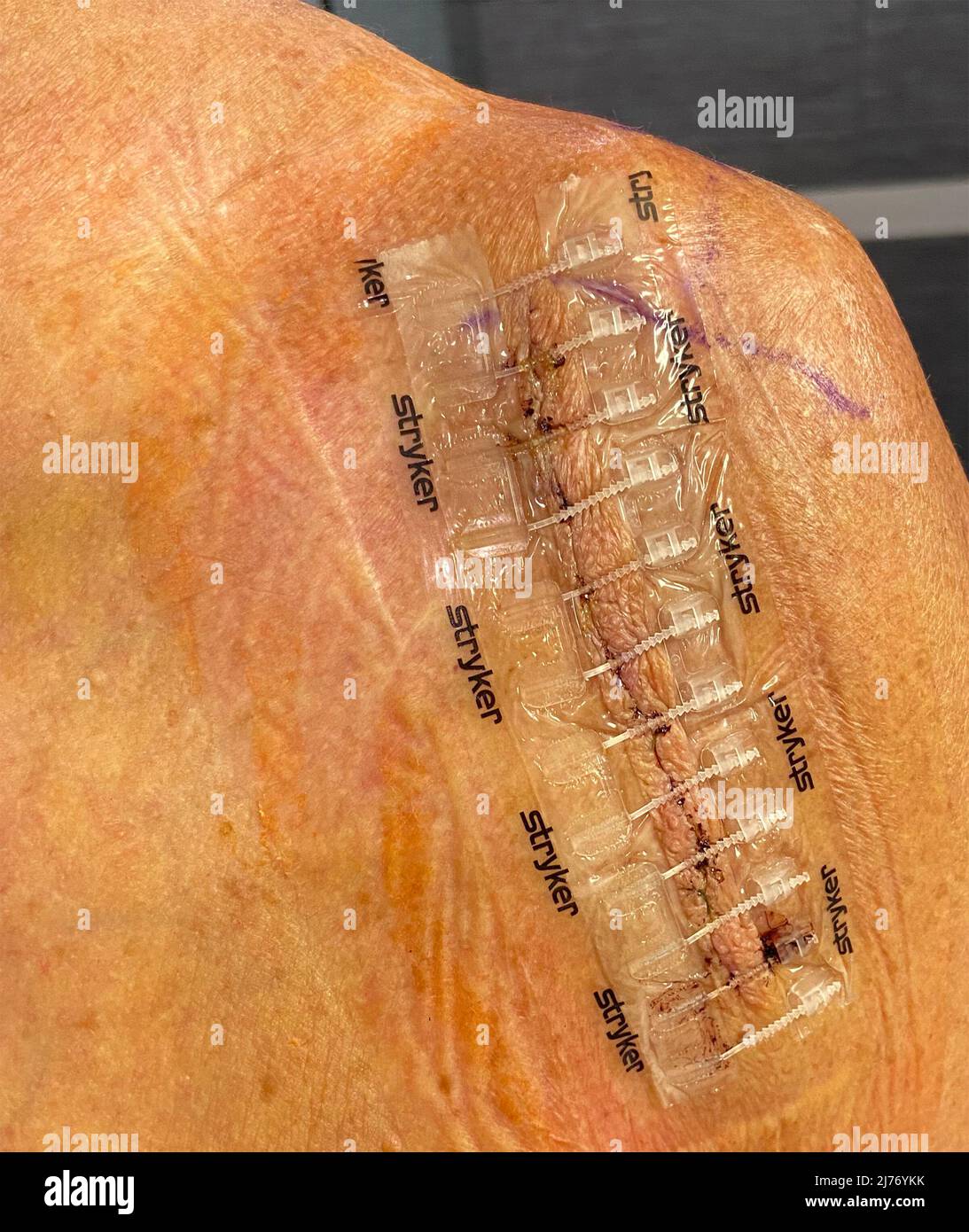 Une arthroplastie totale du genou chez la femme Banque D'Images