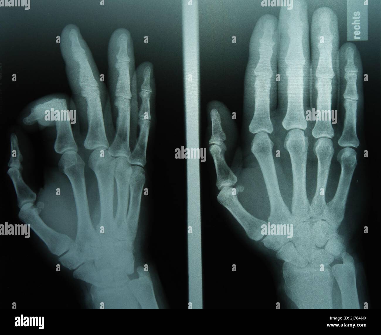 Röntgenbild der beiden Hände Banque D'Images