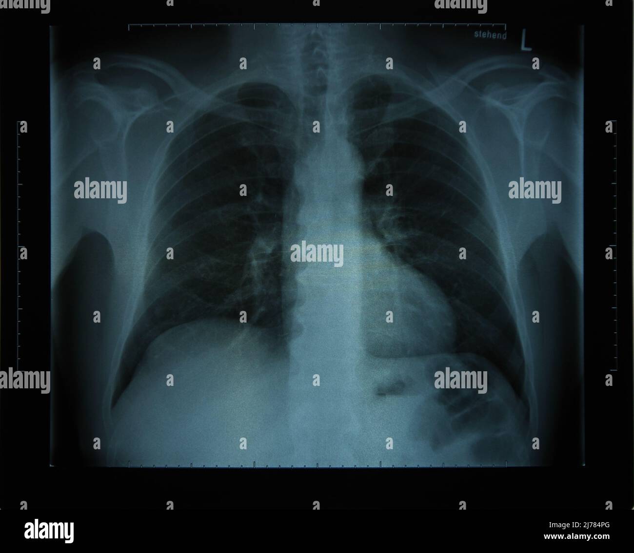 Röntgenbild eines Oberkörpers Banque D'Images
