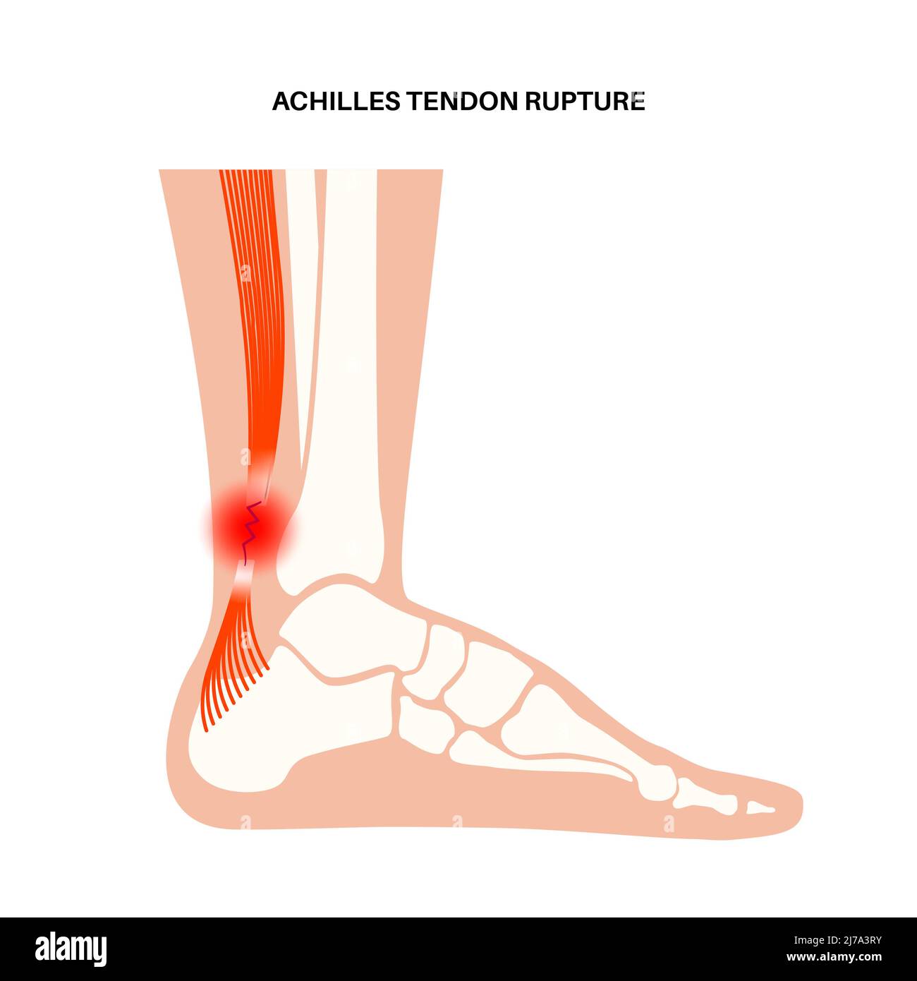 Lésion du tendon d'Achille, illustration Banque D'Images