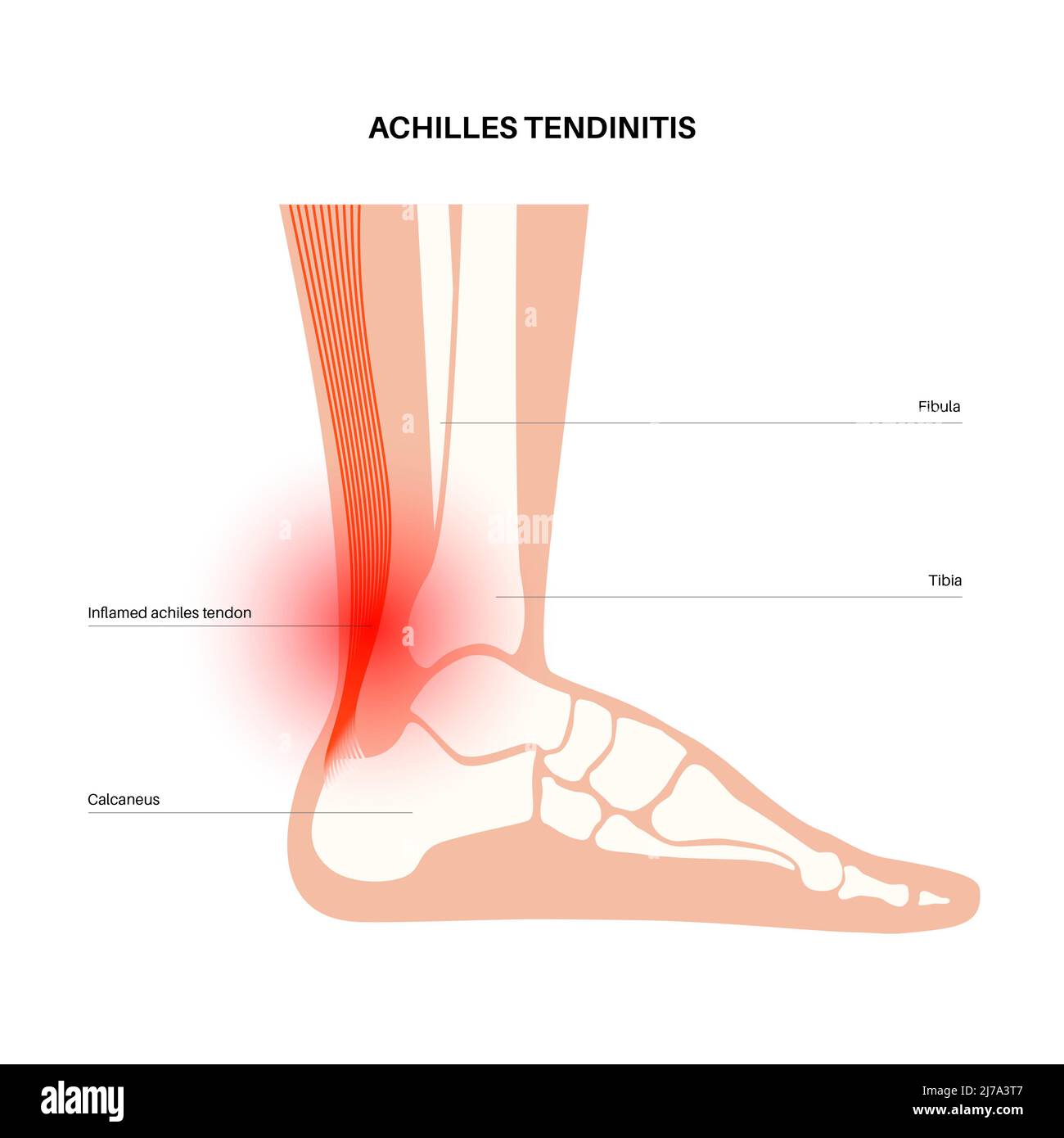 Lésion du tendon d'Achille, illustration Banque D'Images