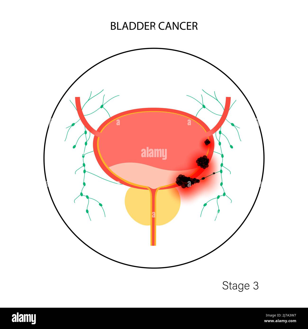 Stades du cancer de la vessie, illustration Banque D'Images