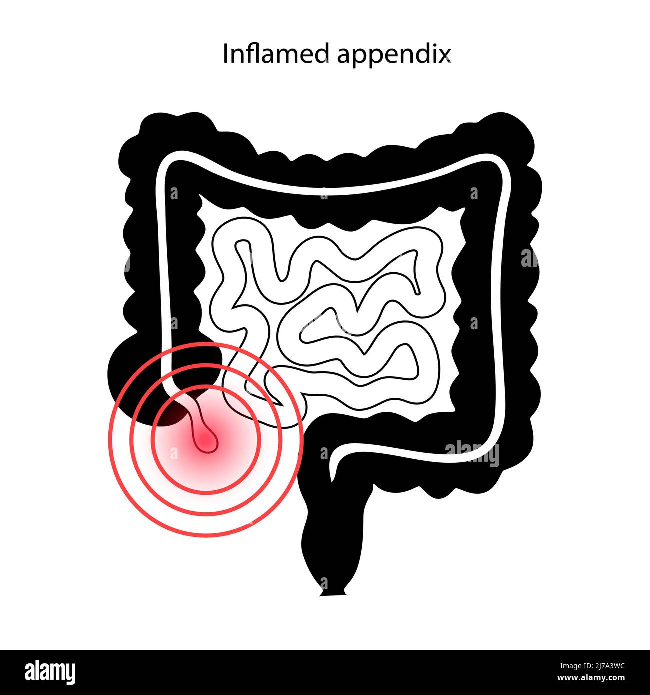Annexe en forme d'inflammation, illustration conceptuelle Banque D'Images