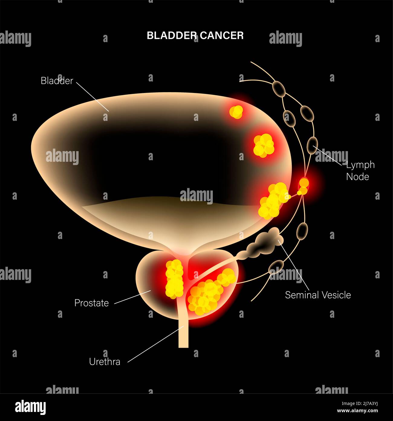 Stades du cancer de la vessie, illustration Photo Stock Alamy — free download