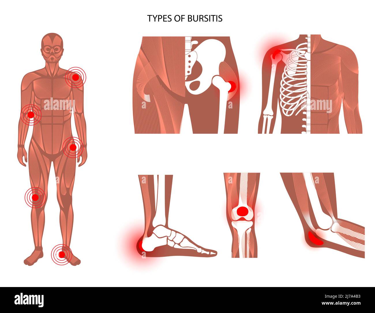 Types de bursite, illustration Banque D'Images