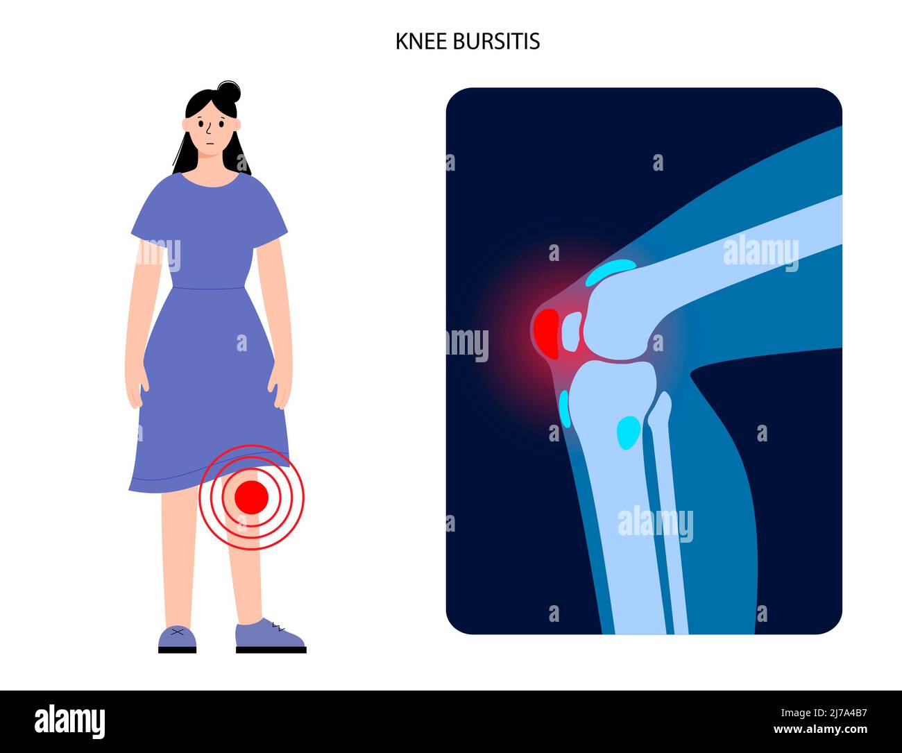 Bursite du genou, illustration conceptuelle Banque D'Images