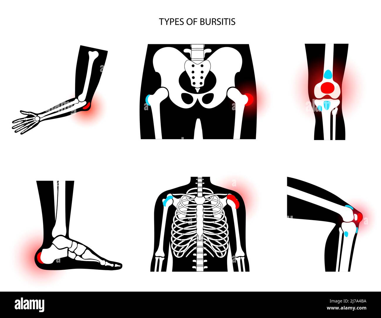 Types de bursite, illustration Banque D'Images