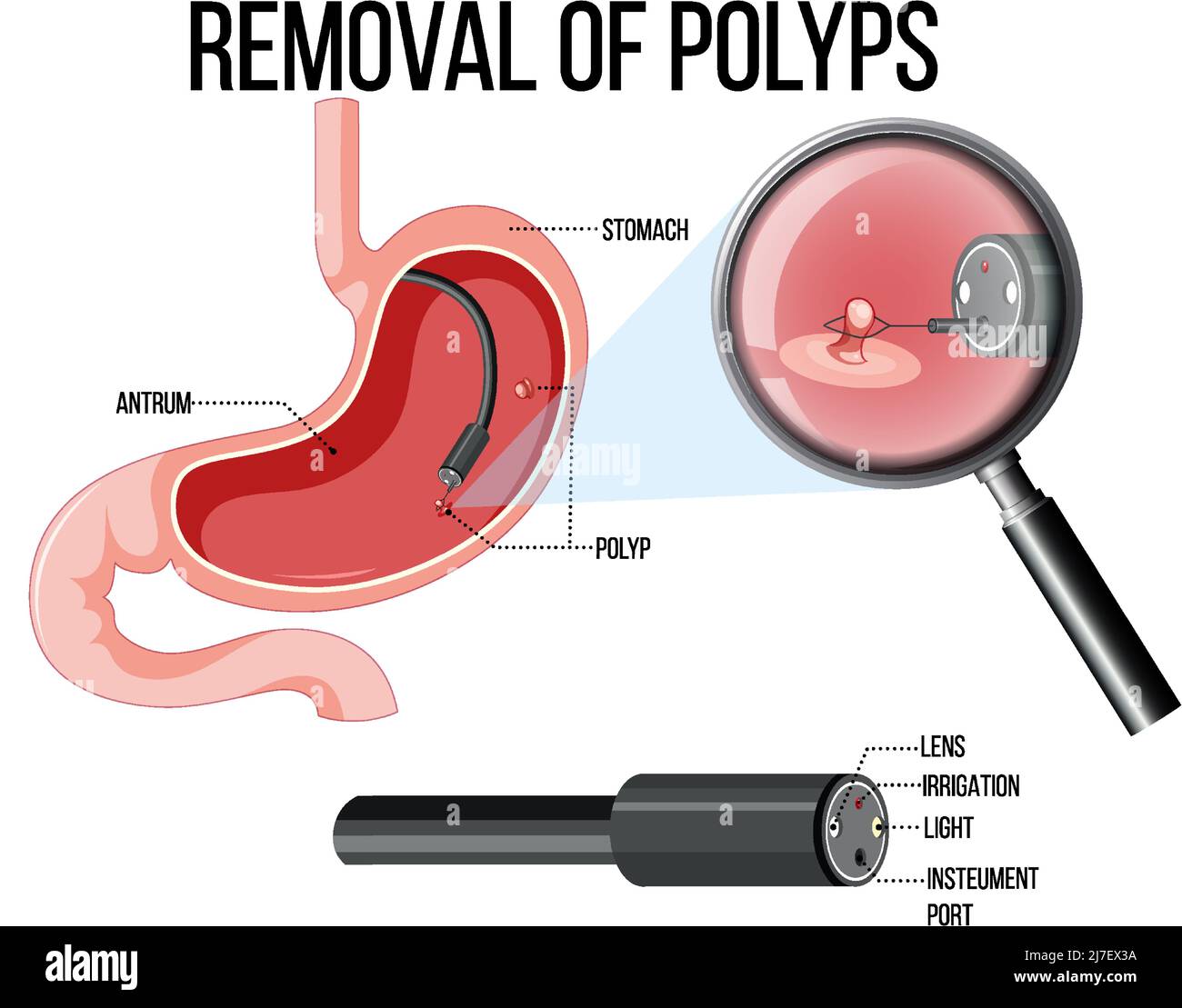 Schéma illustrant la suppression des polypes Illustration de Vecteur