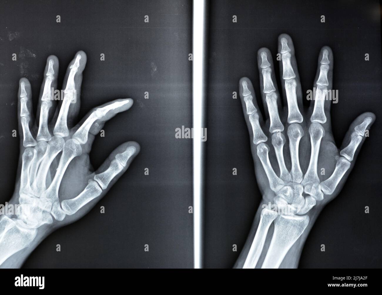 Une radiographie simple montre une base de fracture d'avulsion de la phalange distale du doigt central gauche, fracture d'un petit morceau d'os attaché à un tendon ou a Banque D'Images