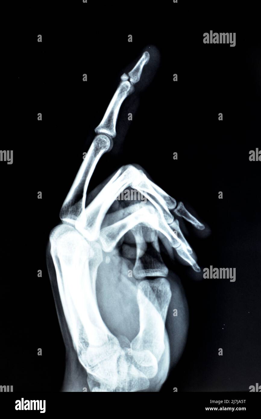 Fracture et déplacement d'un petit morceau d'os de la base du phalange distal du doigt central gauche dans une vue latérale d'une radiographie simple, s Banque D'Images