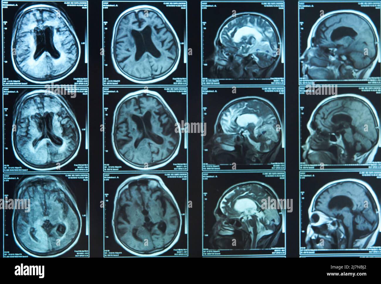 Un instantané de l'acquisition cérébrale d'une personne âgée sur un film IRM d'imagerie par résonance magnétique, pour le diagnostic neurologique médical des maladies cérébrales. Banque D'Images