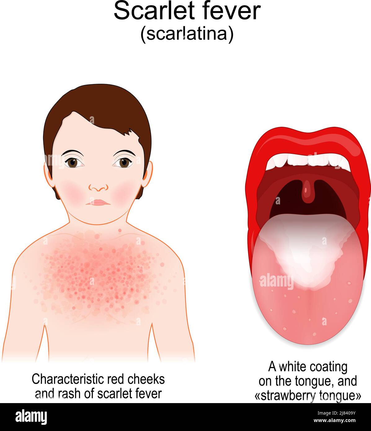 Fièvre des cicatrices. Signes et symptômes de Scarlatina. Enfant avec éruption cutanée et joues rouges caractéristiques. Maladie infectieuse. Bouche et gorge Illustration de Vecteur