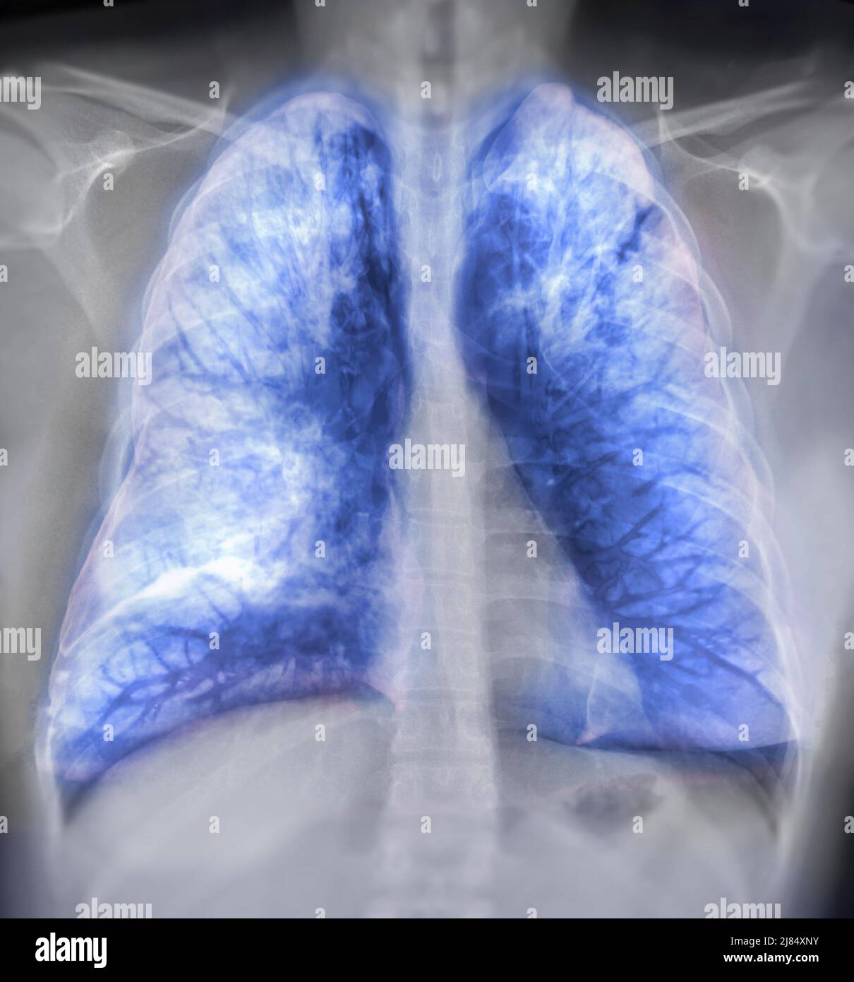 Image de rendu poumon 3D pour le diagnostic TB, tuberculose et Covid-19 à partir du scanner CT-scanner 3D. Banque D'Images