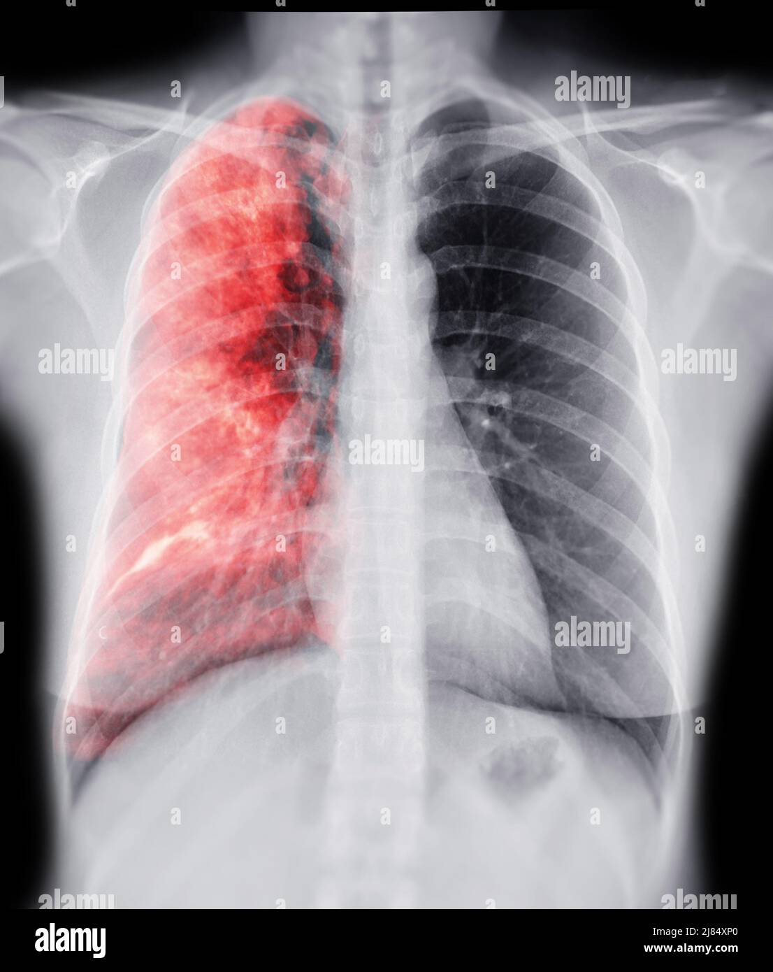 Radiographie thoracique avec Lung 3D image de rendu pour le diagnostic TB, tuberculose et covid-19 . Banque D'Images