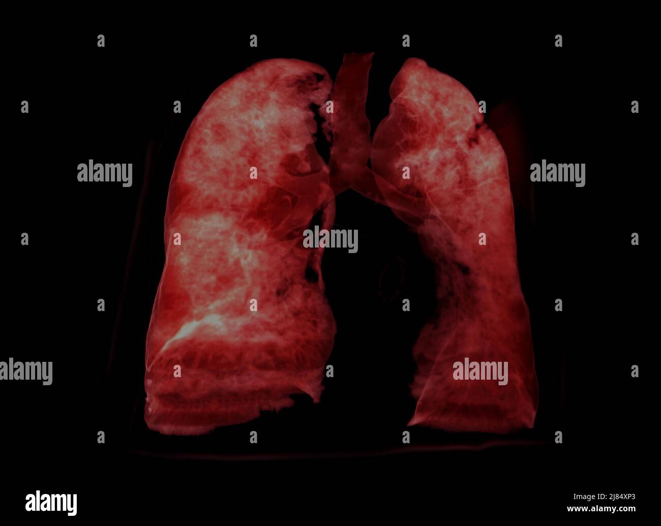 Image de rendu poumon 3D pour le diagnostic TB, tuberculose et Covid-19 à partir du scanner CT-scanner 3D. Banque D'Images