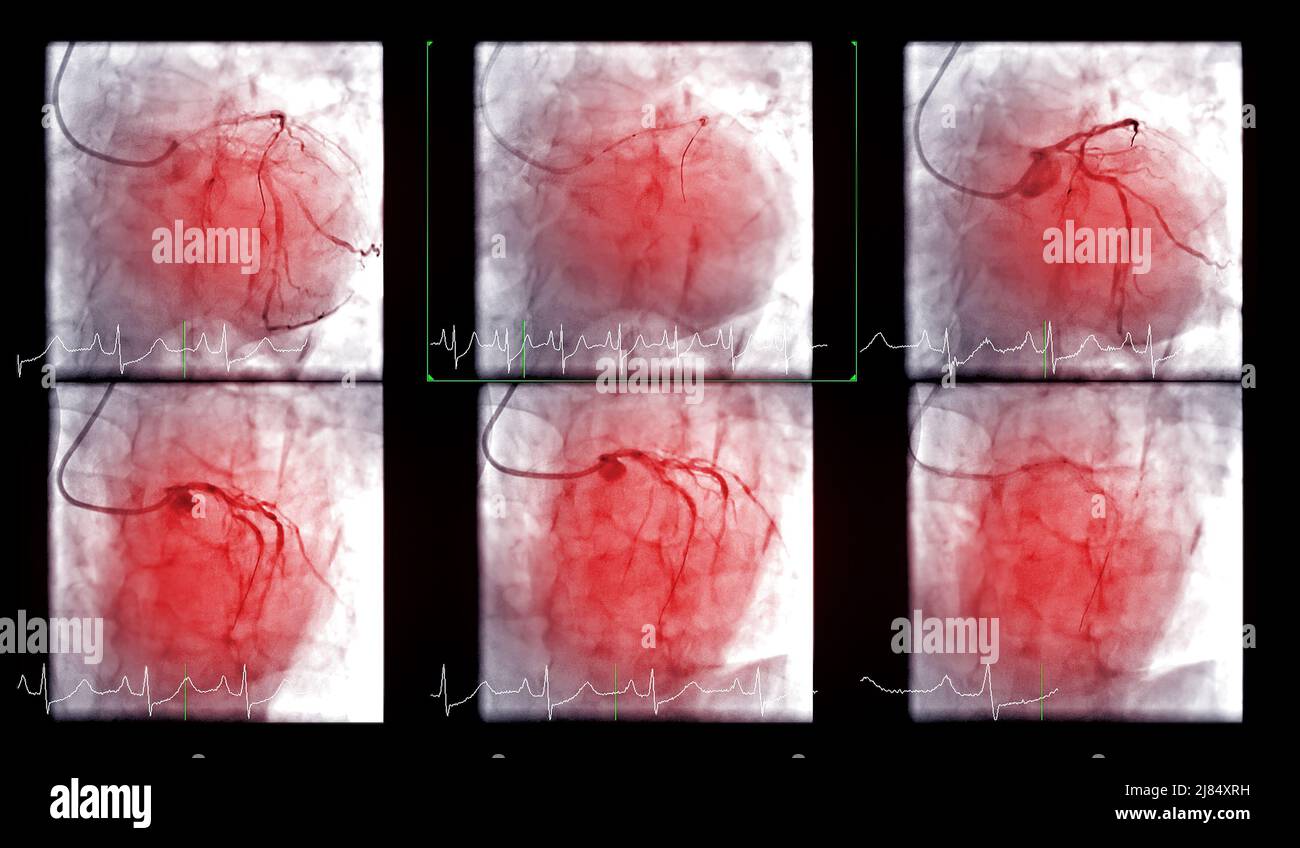 Le cathétérisme cardiaque est un test utilisé pour découvrir l'arrêt cardiaque . Banque D'Images