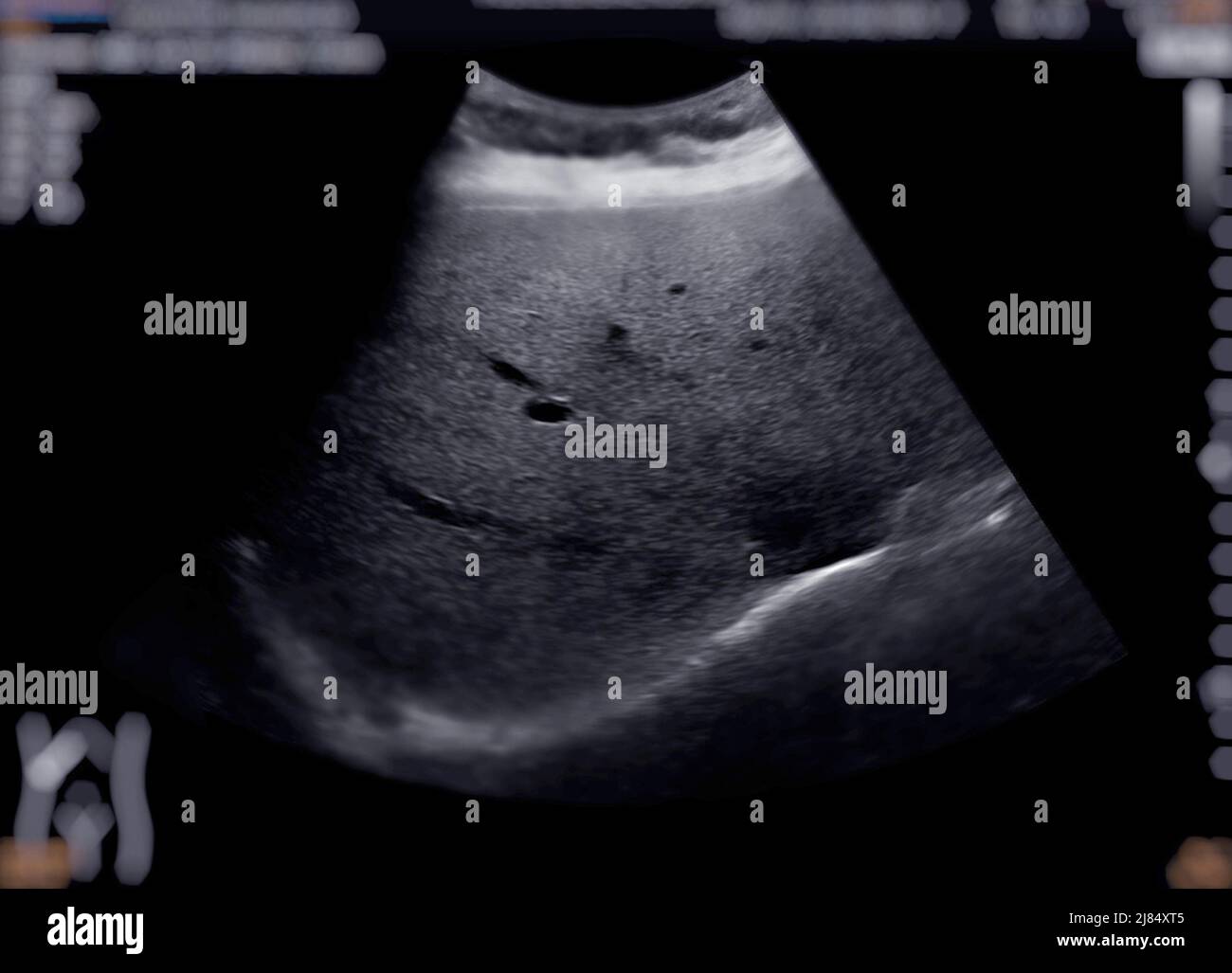 Échographie du haut de l'abdomen montrant le foie et la vésicule biliaire pour le dépistage du carcinome des cellules hépatiques et de la calculs biliaires. Banque D'Images