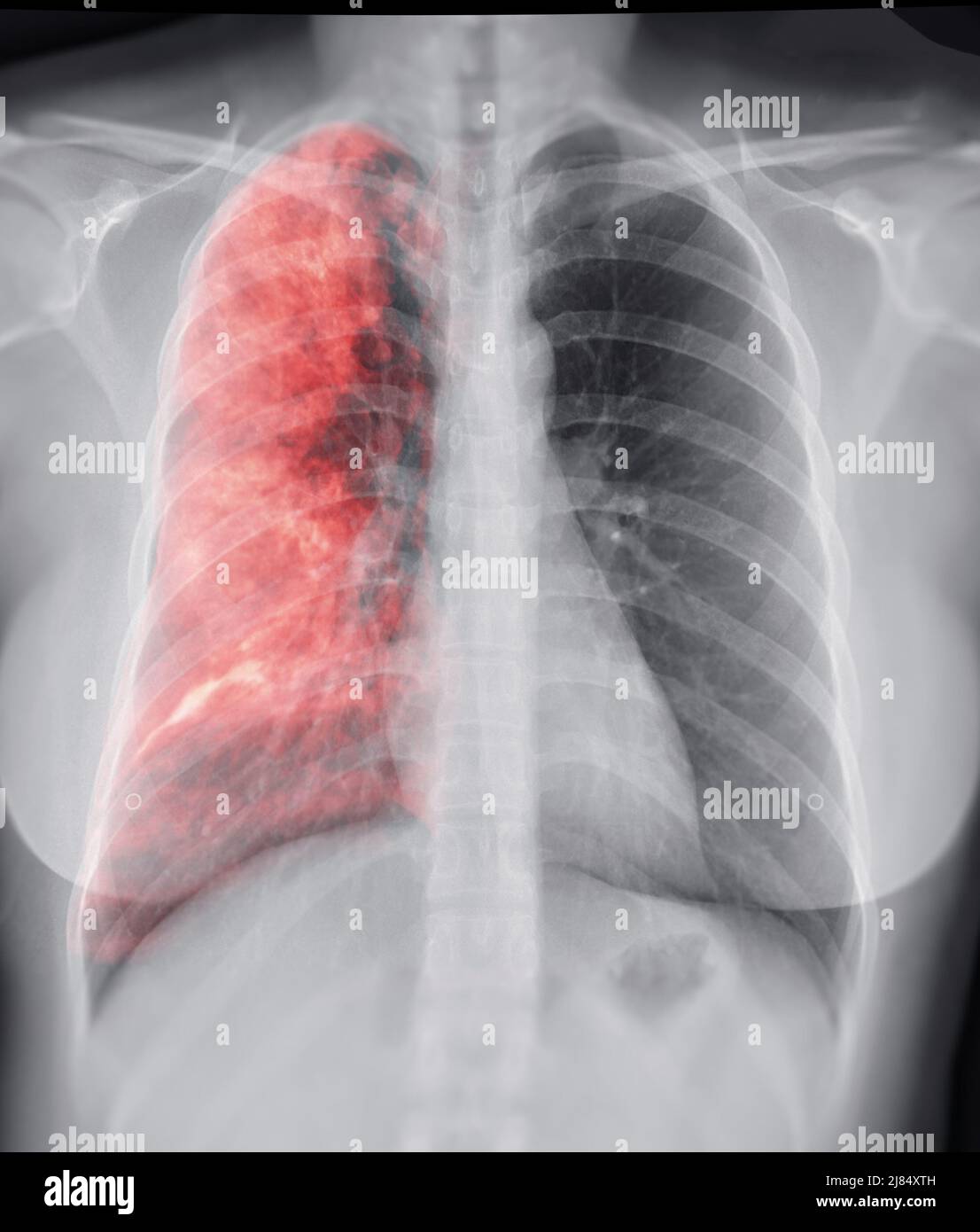 Radiographie thoracique avec Lung 3D image de rendu pour le diagnostic TB, tuberculose et covid-19 . Banque D'Images