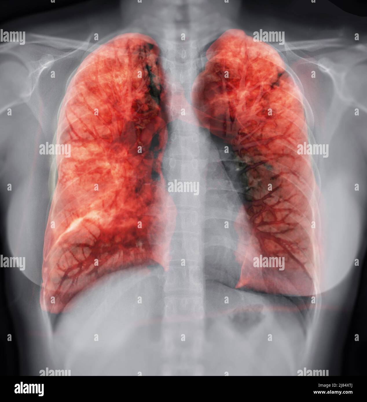 Image de rendu poumon 3D pour le diagnostic TB, tuberculose et Covid-19 à partir du scanner CT-scanner 3D. Banque D'Images