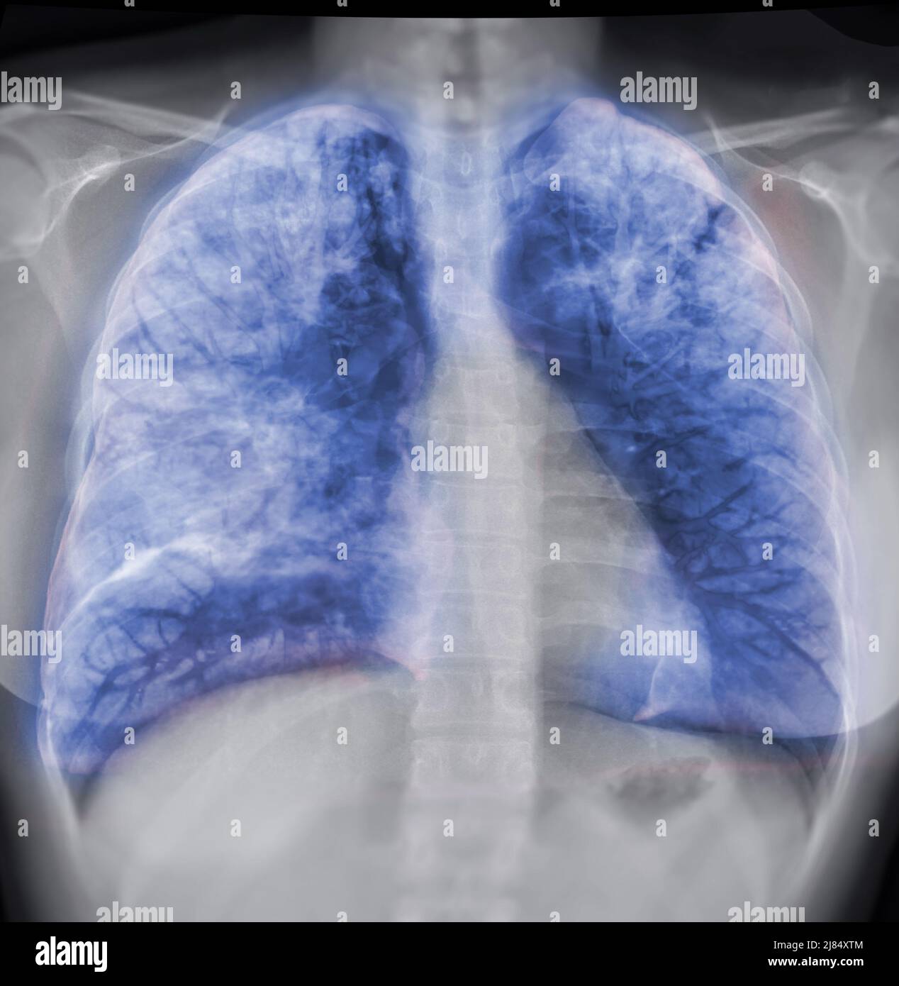Image de rendu poumon 3D pour le diagnostic TB, tuberculose et Covid-19 à partir du scanner CT-scanner 3D. Banque D'Images