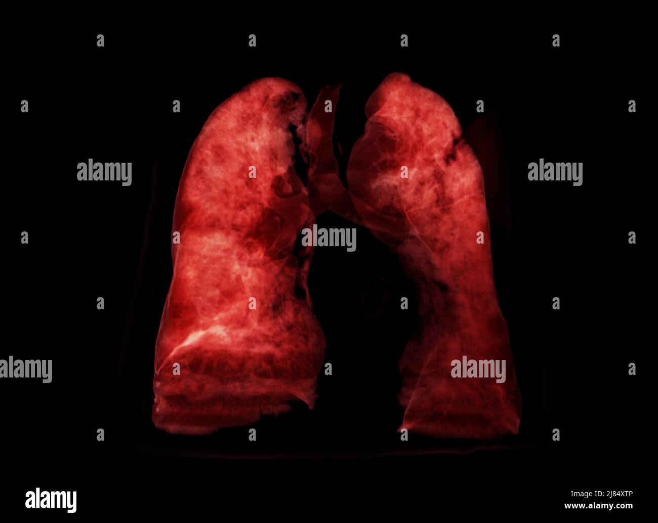 Image de rendu poumon 3D pour le diagnostic TB, tuberculose et Covid-19 à partir du scanner CT-scanner 3D. Banque D'Images