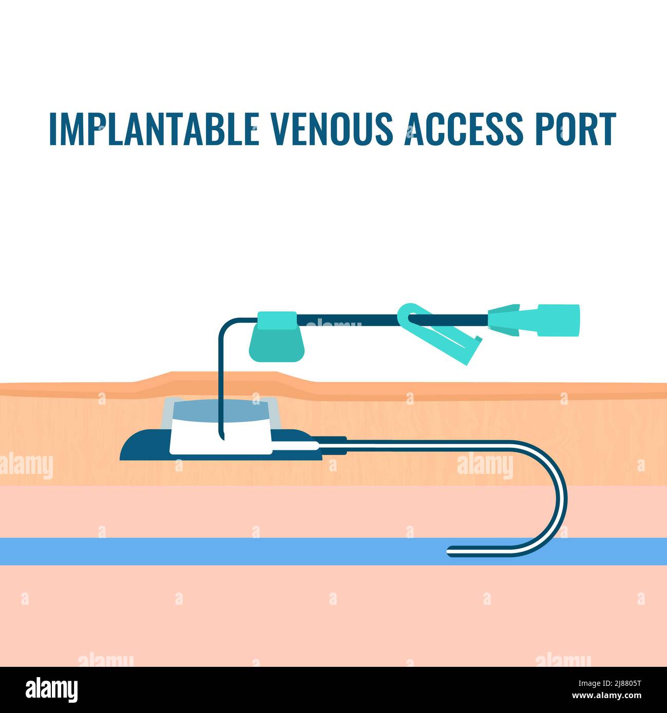 Port d'accès veineux, illustration Banque D'Images