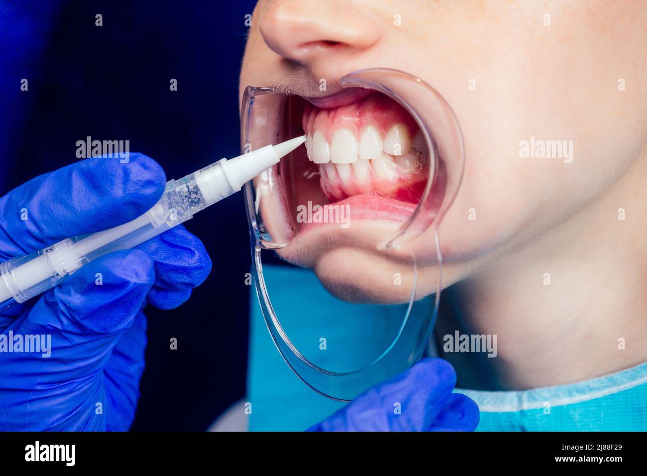 belle femme au gingembre à tête rouge avec bouche ouverte et embout buccal chez le dentiste portant un plateau de blanchiment en plastique Banque D'Images
