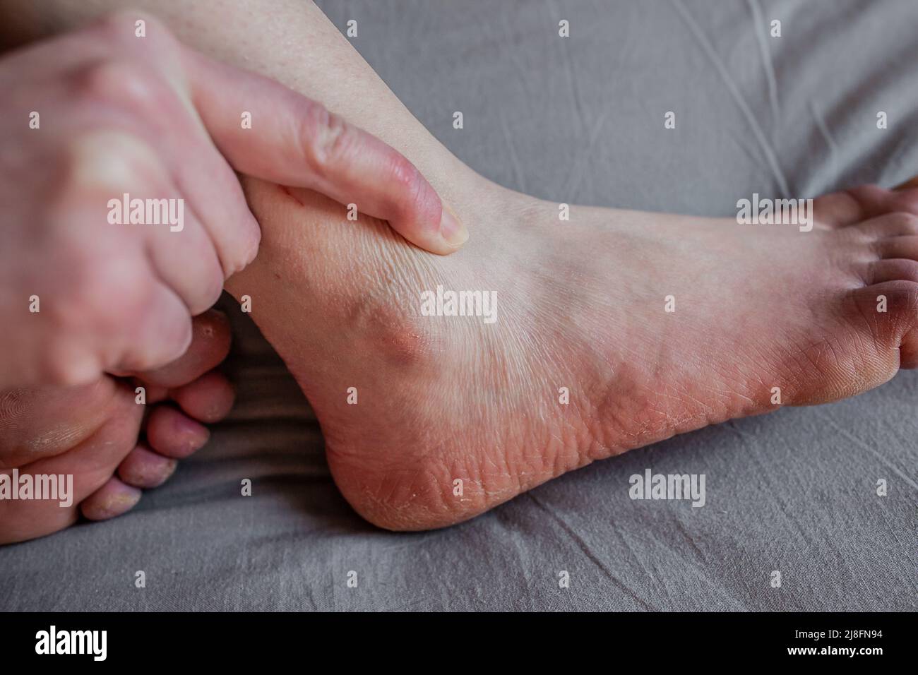 Pied de personne avec le syndrome de Raynaud et d'EhlersDanlos avec — free download
