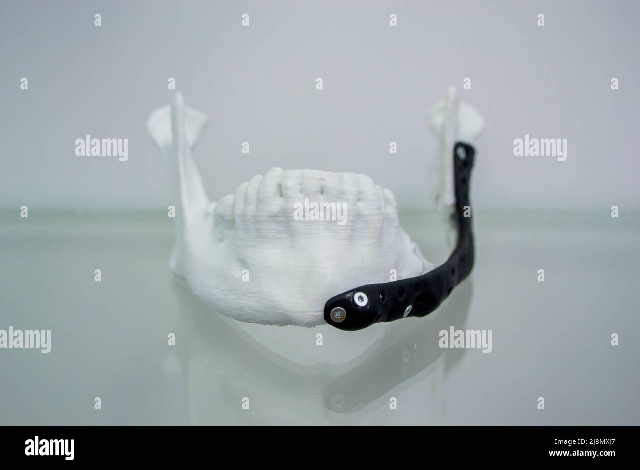 Implantation de l'endoprothèse de la mâchoire inférieure. Imprimante 3D à mâchoire inférieure Banque D'Images