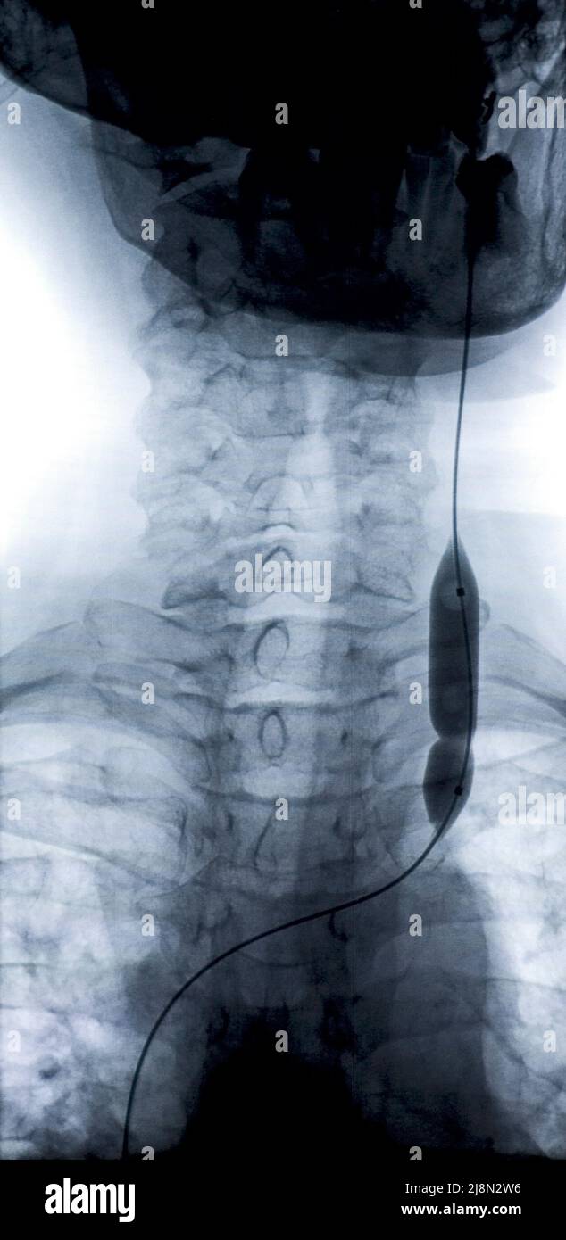 9 août 2010. Utilisation d'un cathéter à ballonnet en angioplastie coronaire observée sur l'image radiologique, dans la veine jugulaire interne d'un patient. (CTK photo/Grzegorz Klatka) Banque D'Images