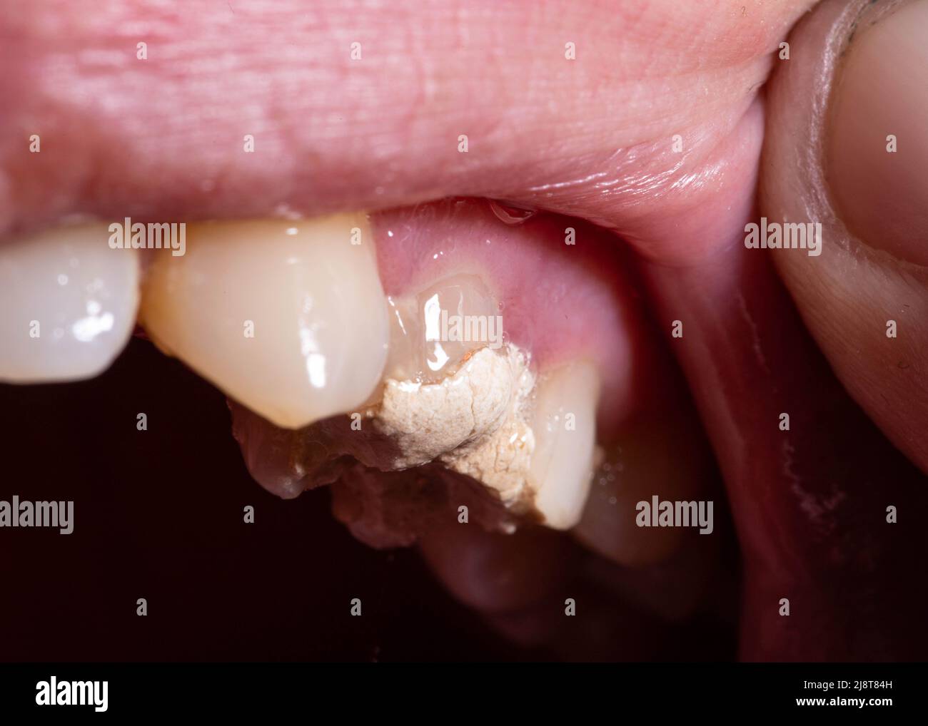Remplissage des dents avec du ciment temporaire pour le traitement des — free download