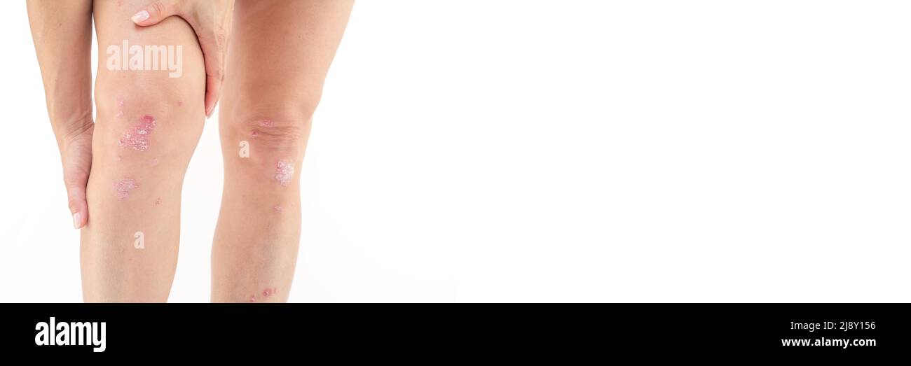 Épanchement de l'articulation du genou.arthrite Psoriatique, lésion du ménisque.excès de liquide synovial dans et autour de l'articulation du genou gauche sur fond blanc Banque D'Images Épanchement de l'articulation du genou.arthrite Psoriatique, lésion du ménisque.excès de liquide synovial dans et autour de l'articulation du genou gauche sur fond blanc Banque D'Images