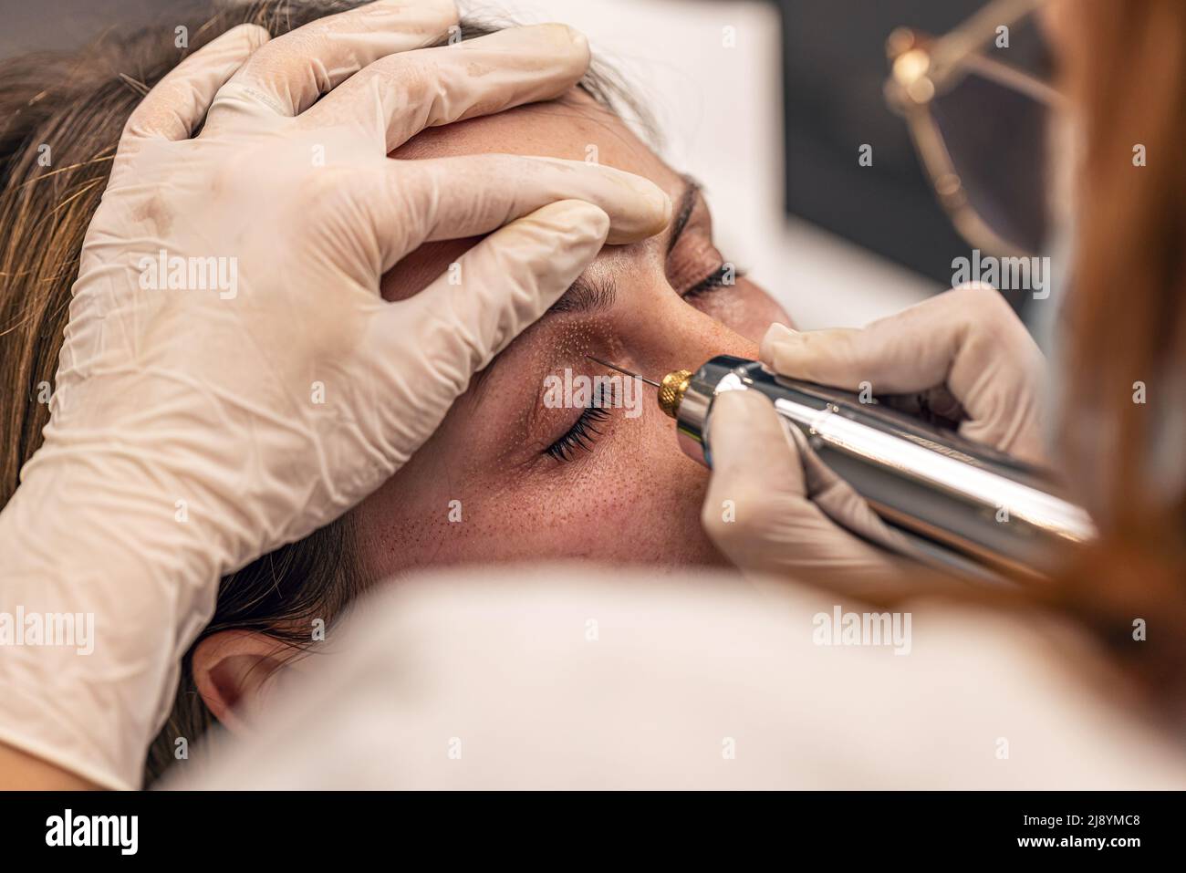 Procédures cosmétiques non chirurgicales pour les yeux par la technique de fibroblaste de plasma Banque D'Images