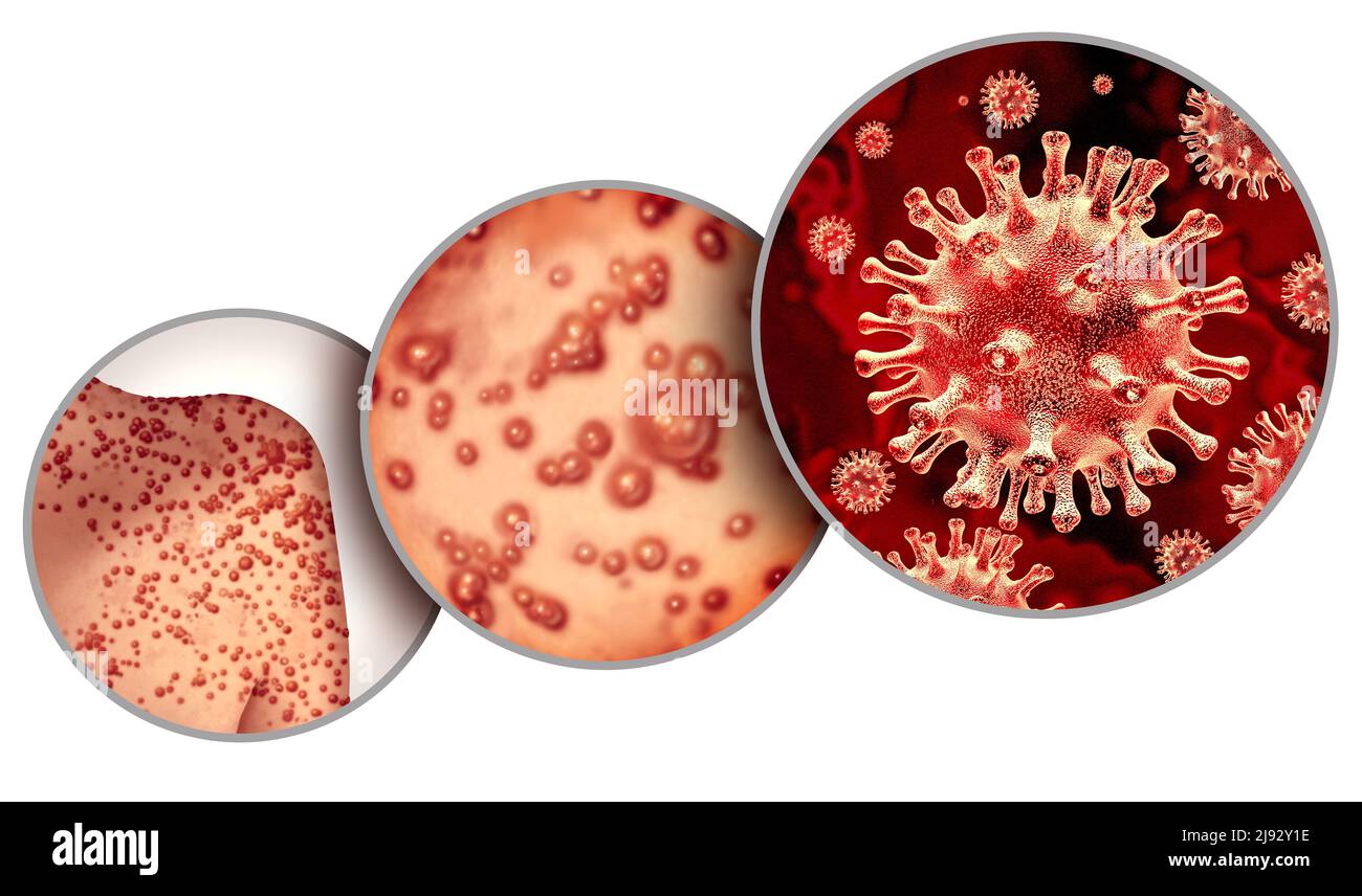 Le virus de la variole du singe est une infection contagieuse sous forme de cloques et de poisons sur la peau représentant la transmission d'une personne infectée. Banque D'Images Le virus de la variole du singe est une infection contagieuse sous forme de cloques et de poisons sur la peau représentant la transmission d'une personne infectée. Banque D'Images
