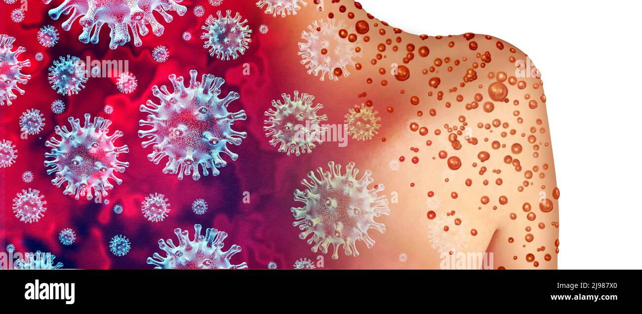 Virus contagieux de la variole comme une infection contagieuse sous forme de cloques et de poisons sur la peau représentant la transmission d'une personne infectée. Banque D'Images Virus contagieux de la variole comme une infection contagieuse sous forme de cloques et de poisons sur la peau représentant la transmission d'une personne infectée. Banque D'Images