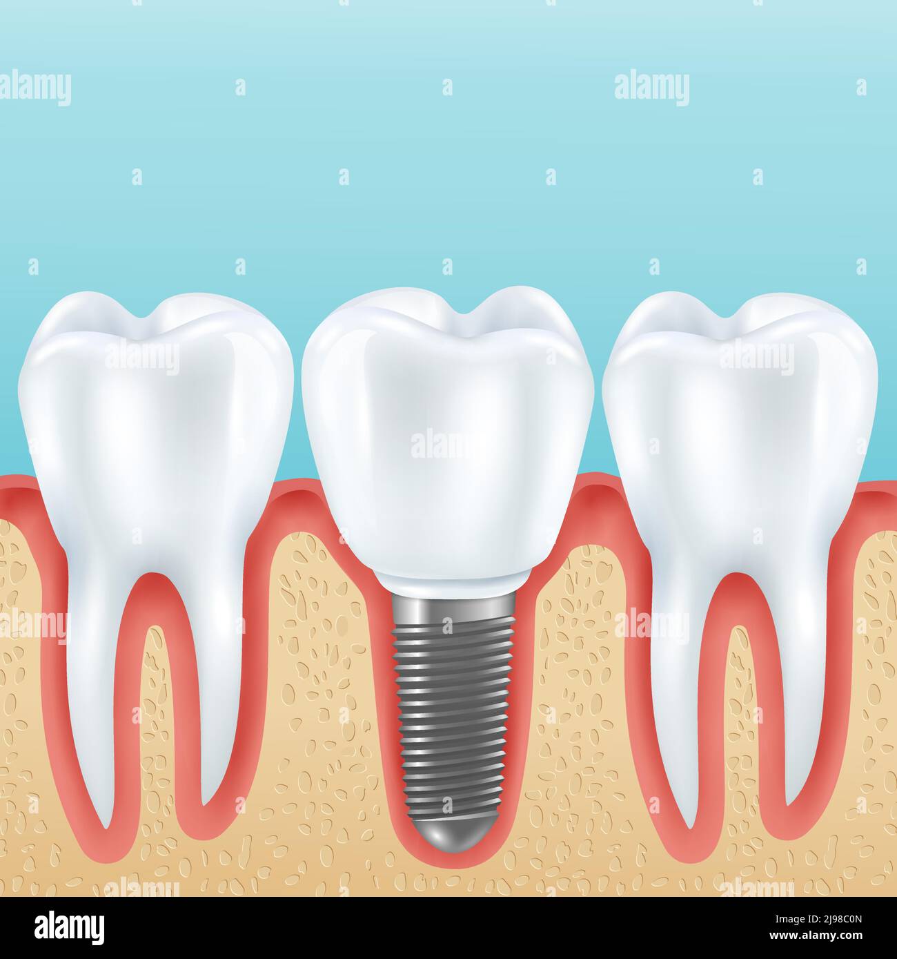 Prothèses dentaires illustration vectorielle réaliste avec dents et prothèses saines couronne implantée avec des implants Illustration de Vecteur