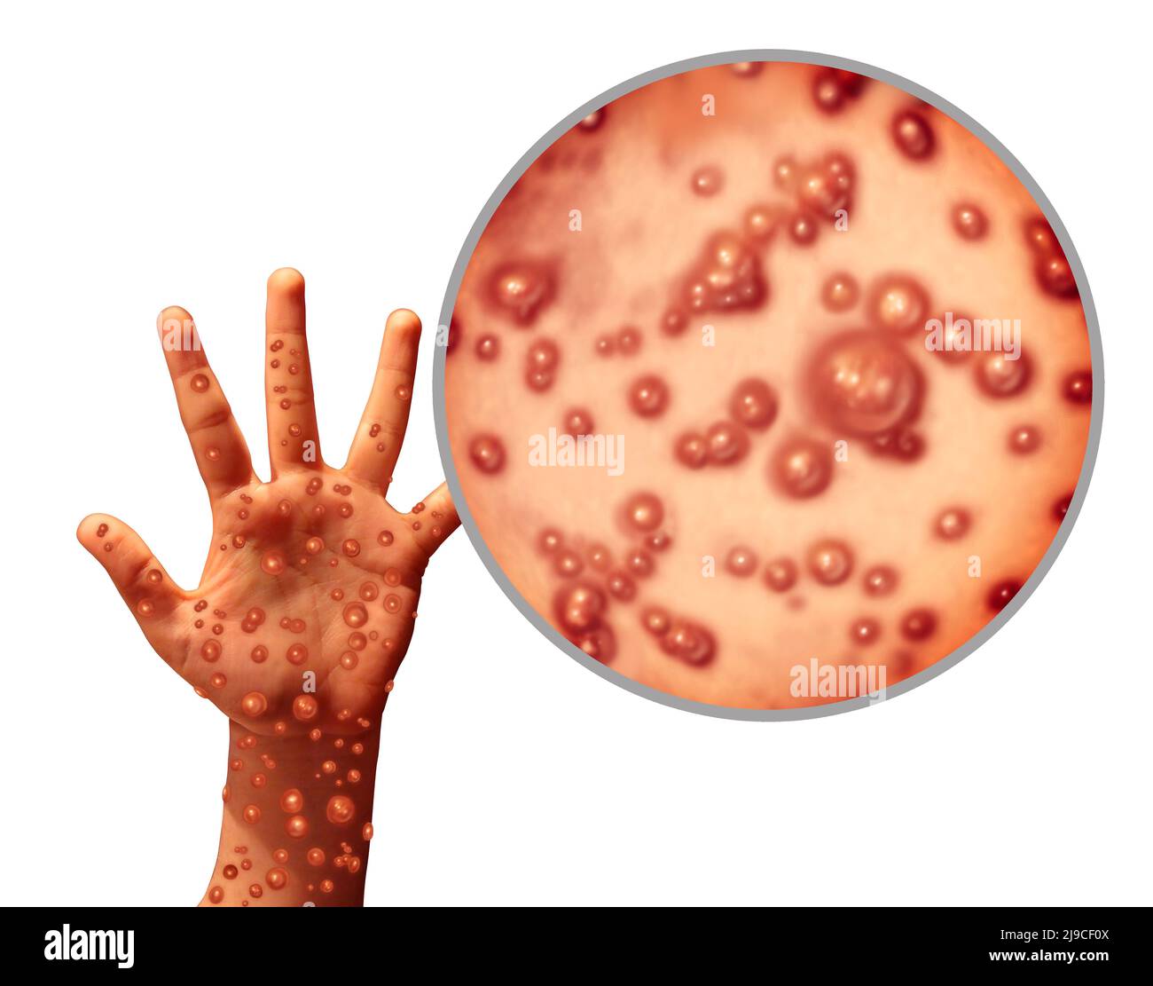 L'infection par le virus de la variole est une maladie contagieuse qui se manifeste par des cloques et des lessivielles sur la peau représentant la transmission d'une personne infectée. Banque D'Images L'infection par le virus de la variole est une maladie contagieuse qui se manifeste par des cloques et des lessivielles sur la peau représentant la transmission d'une personne infectée. Banque D'Images