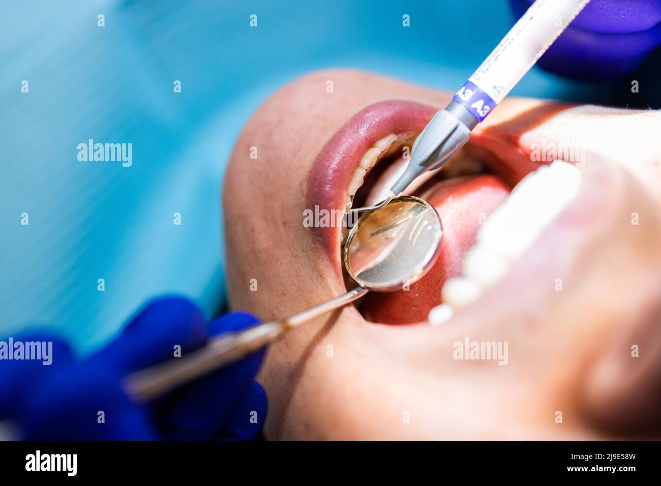 Dentiste méconnaissable effectuant une procédure de remplissage dentaire à une patiente Banque D'Images
