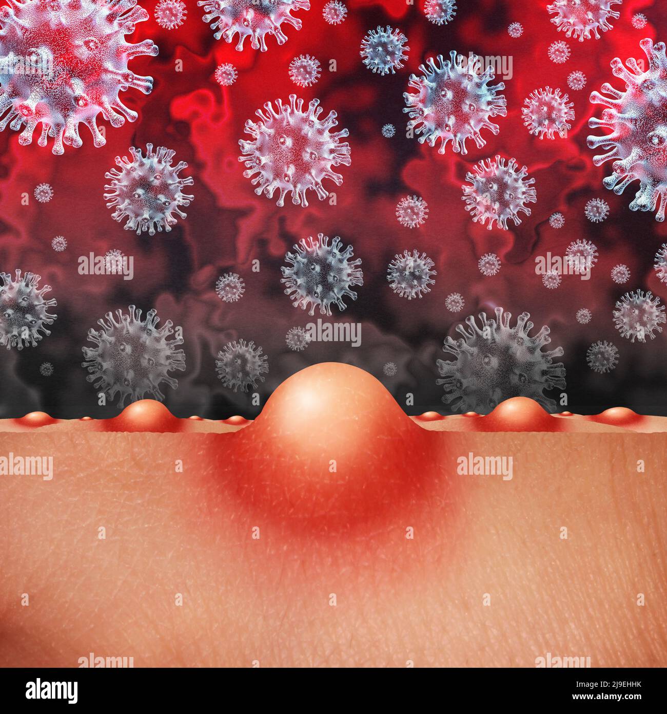 Le virus de la variole du singe est une infection contagieuse sous forme de cloques et de poisons sur la peau représentant la transmission d'une personne infectée. Banque D'Images Le virus de la variole du singe est une infection contagieuse sous forme de cloques et de poisons sur la peau représentant la transmission d'une personne infectée. Banque D'Images