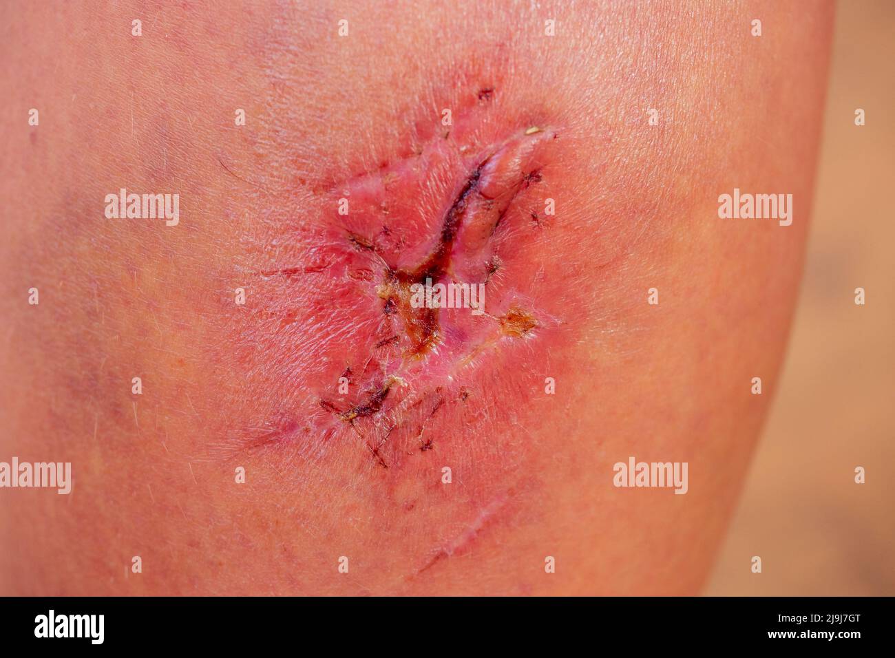 Gros plan de la cicatrice cyanotique keloïde causée par la chirurgie et la suture, les imperfections ou les défauts de la peau. Dermatologie et cosmétologie Banque D'Images