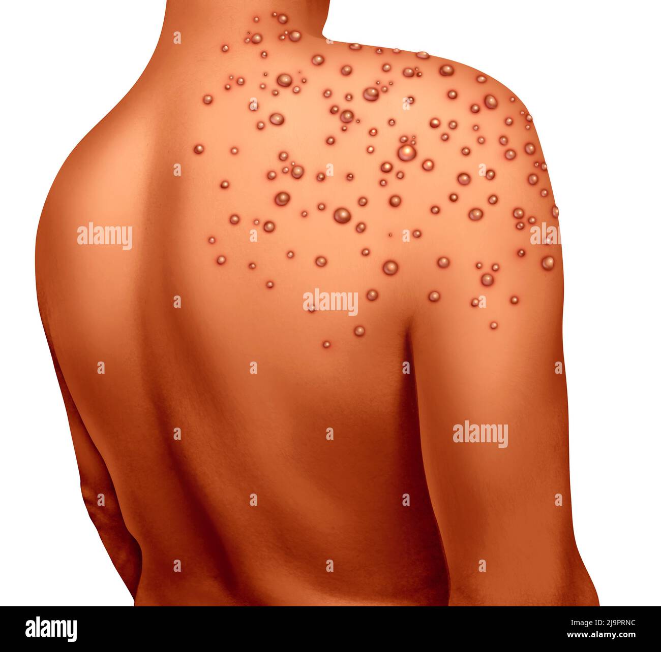 La maladie du virus de la varicelle et l'épidémie de la variole comme une infection contagieuse comme des cloques et des laisons sur la peau représentant la transmission d'une infection. Banque D'Images La maladie du virus de la varicelle et l'épidémie de la variole comme une infection contagieuse comme des cloques et des laisons sur la peau représentant la transmission d'une infection. Banque D'Images
