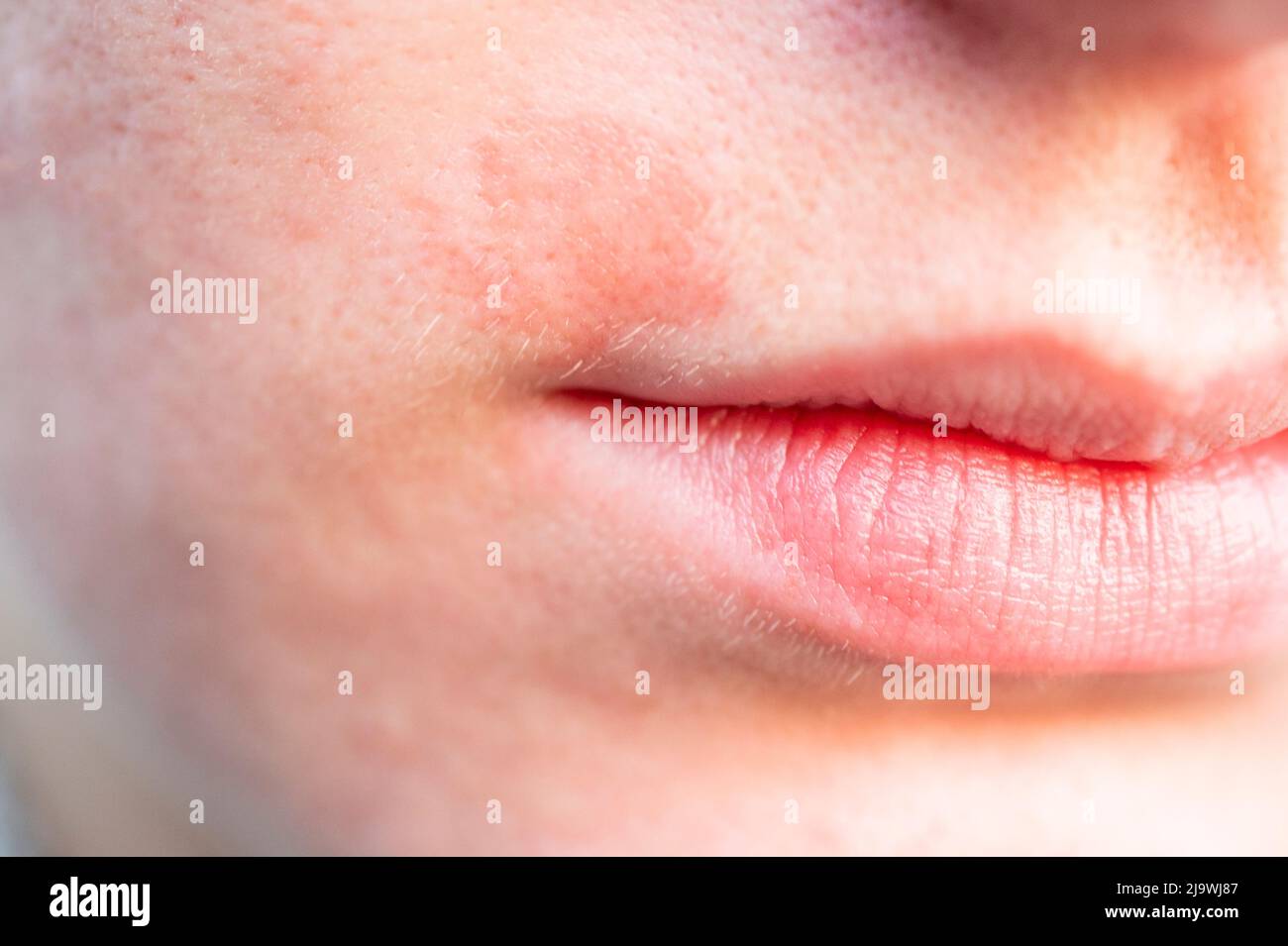 Irritation de la peau sur le visage Photo Stock - Alamy