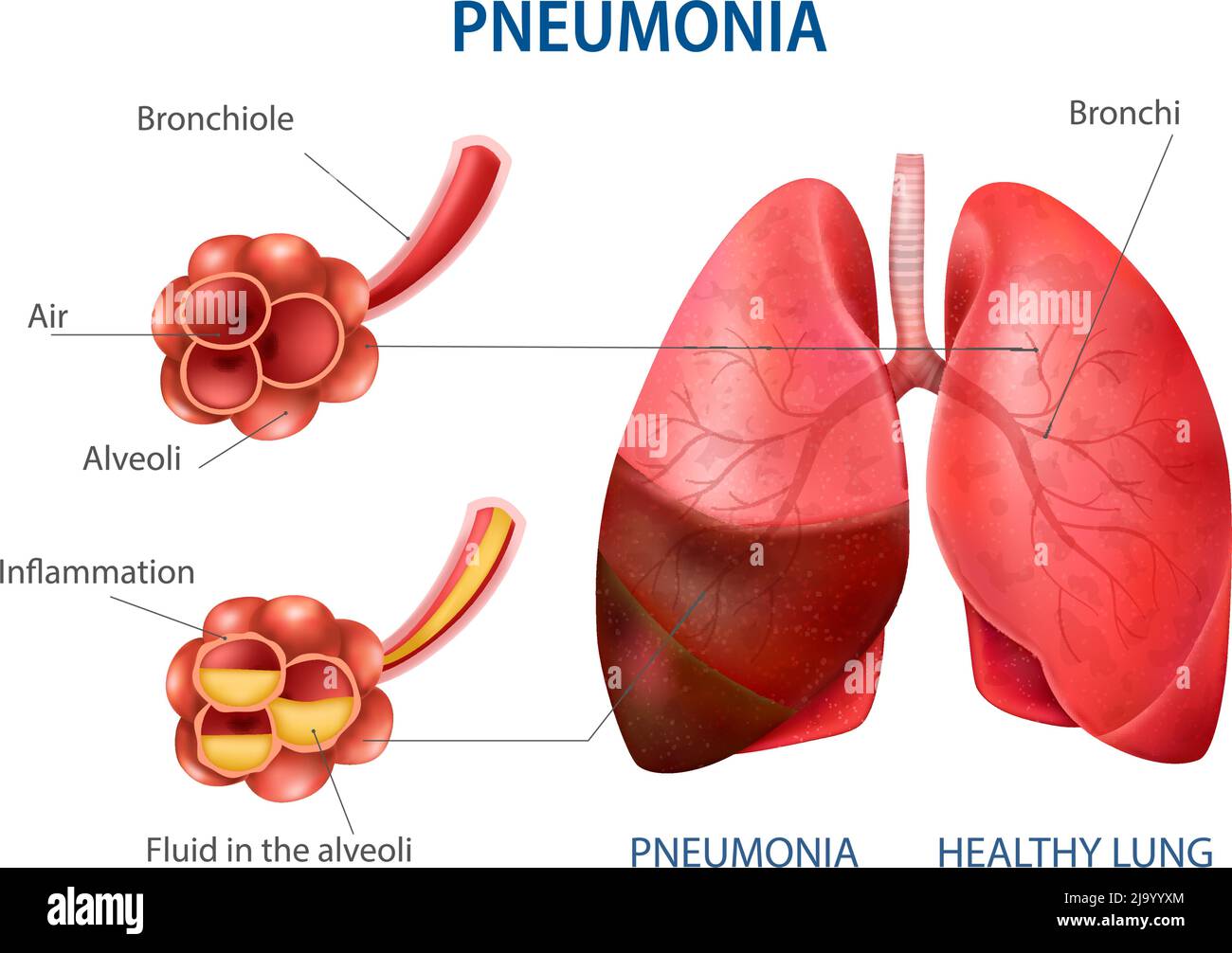 Ensemble réaliste de pneumonie avec illustration vectorielle des symboles pulmonaires sains Illustration de Vecteur