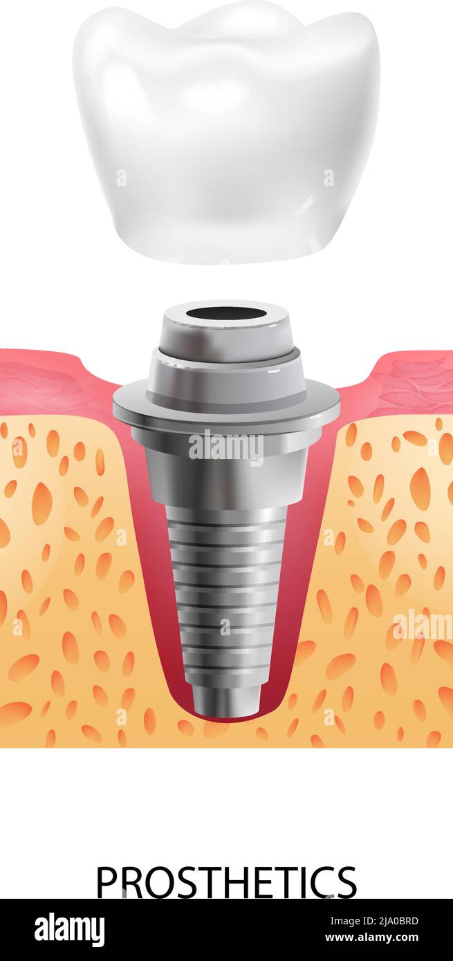 Composition réaliste de l'implant dentaire avec texte et vue de l'étape des prothèses de l'illustration du vecteur d'implantation dentaire Illustration de Vecteur