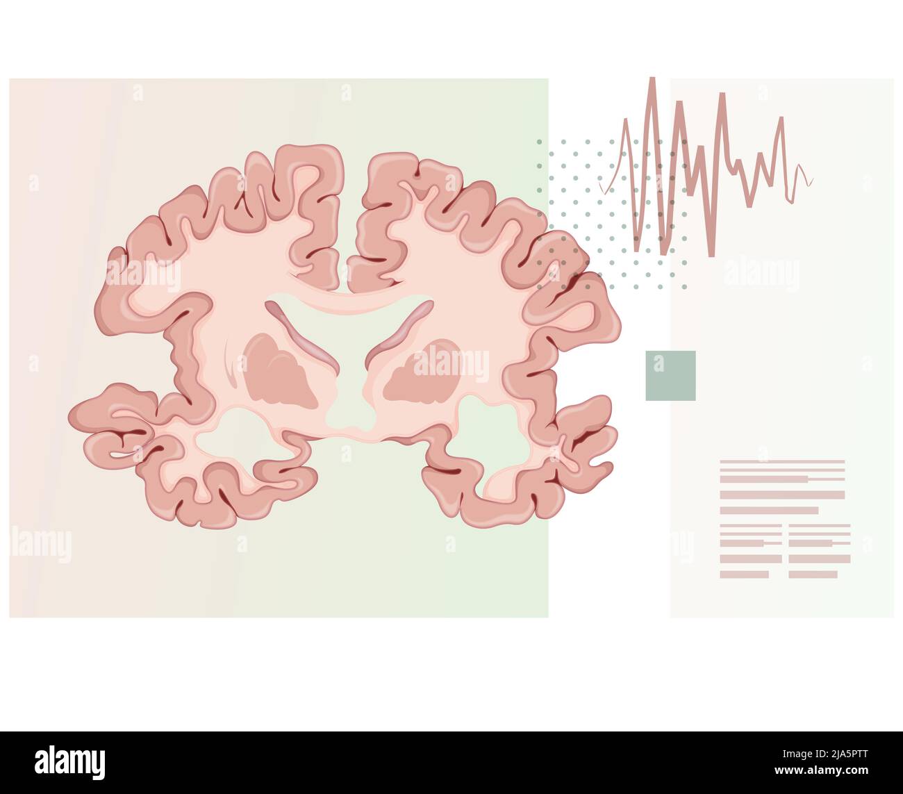 Maladie d'Alzheimer - Section transverse du cerveau - Illustration comme fichier EPS 10 Illustration de Vecteur