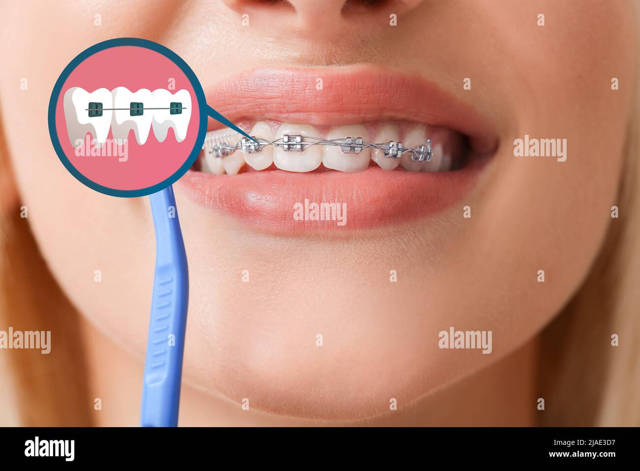 Jeune femme avec bretelles dentaires, gros plan Photo Stock - Alamy